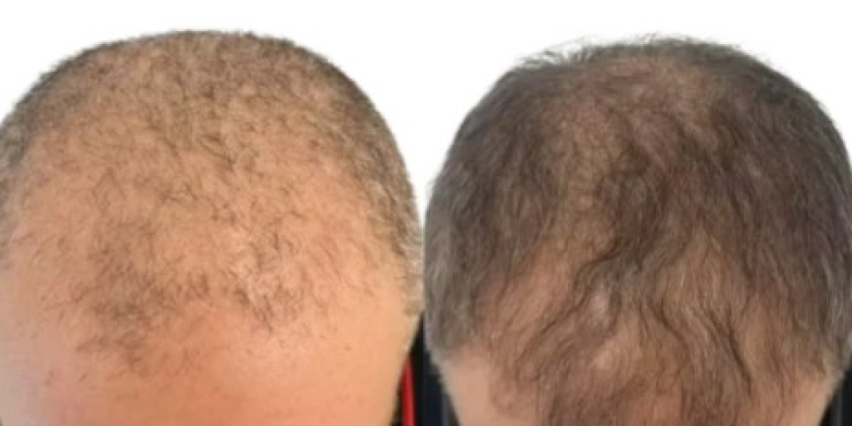 Non-Surgical Hair Regrowth & Skin Treatments in Brisbane & Gold Coast – Affordable PRP Therapy from Just $999