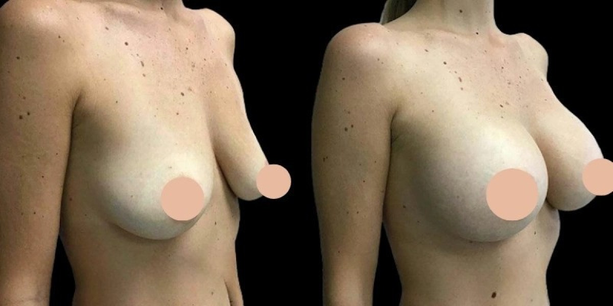 Breast Augmentation in Dubai Talking to Your Partner
