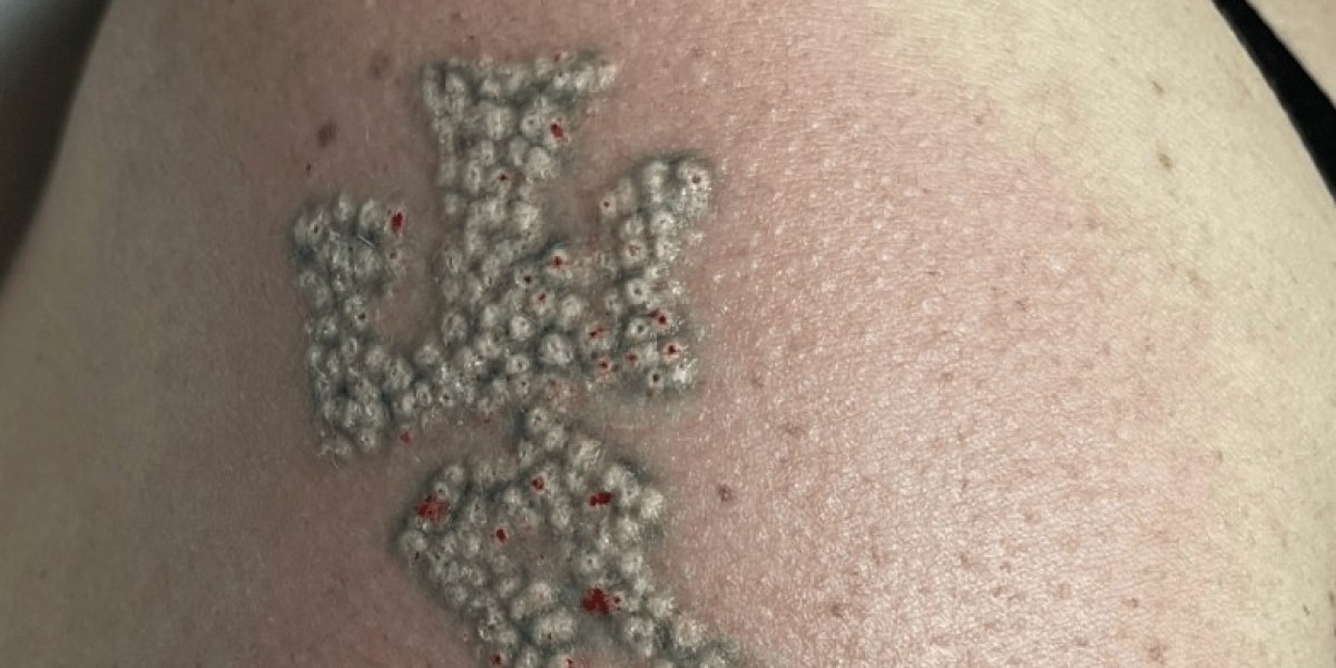 Laser Tattoo Removal: What Happens After Each Visit