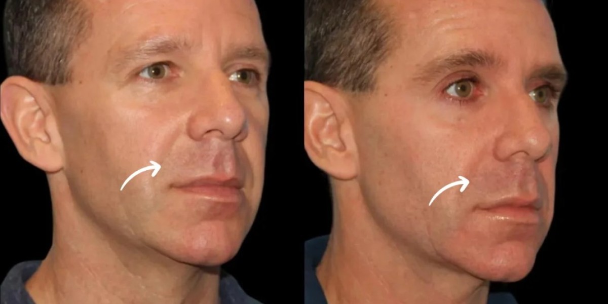 Best Doctors in Dubai and 2025 Insights on Sculptra Fillers