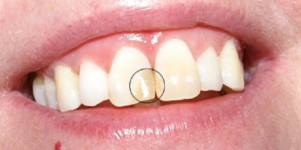 Trám răng đau không? Bác sĩ giải đáp, bí quyết giảm ê buốt hiệu quả