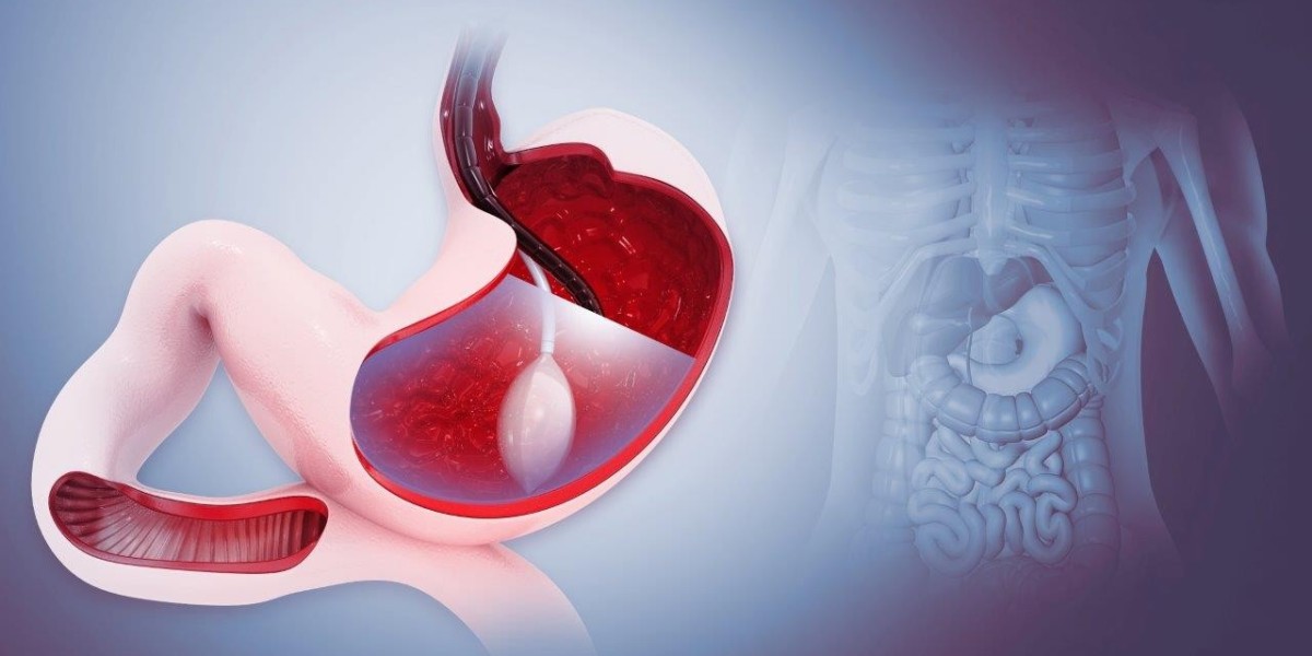 Gastric Balloon: Common Questions Answered