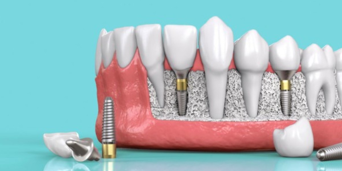 Lấy dấu Implant là gì? Quy trình thực hiện chi tiết nhất
