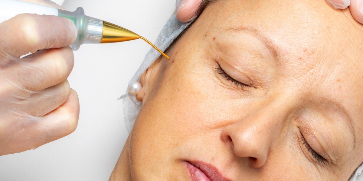 Can Plasma Pen Treat Wrinkles and Fine Lines?