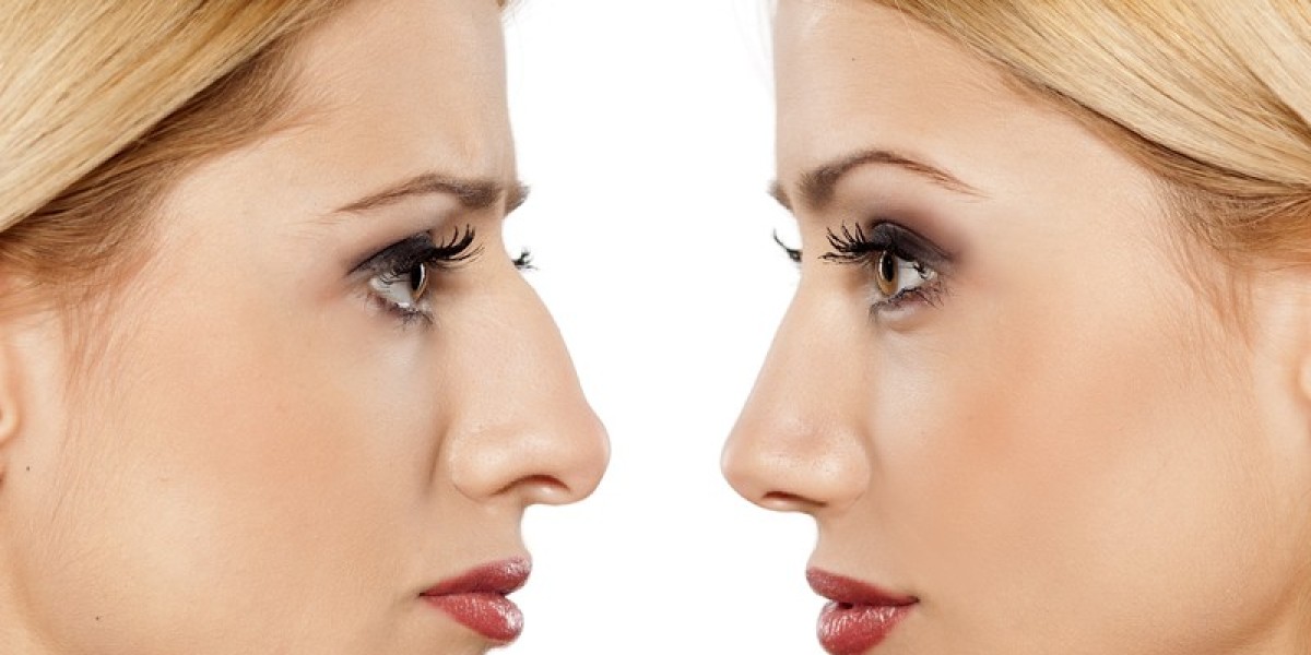 The Best Rhinoplasty Surgeon’s Artistic Touch