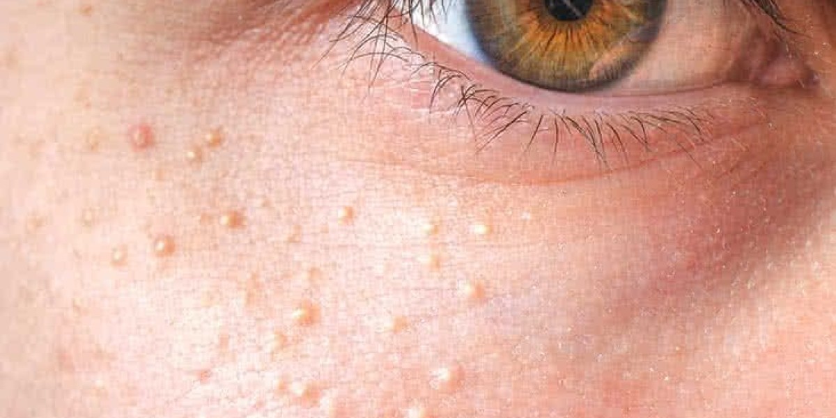 Milia Treatments for Sensitive Skin: Safe Options