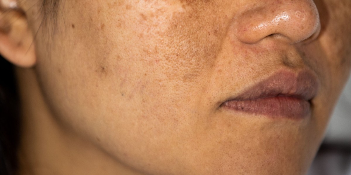 Can Pigmentation Come Back After Treatment?
