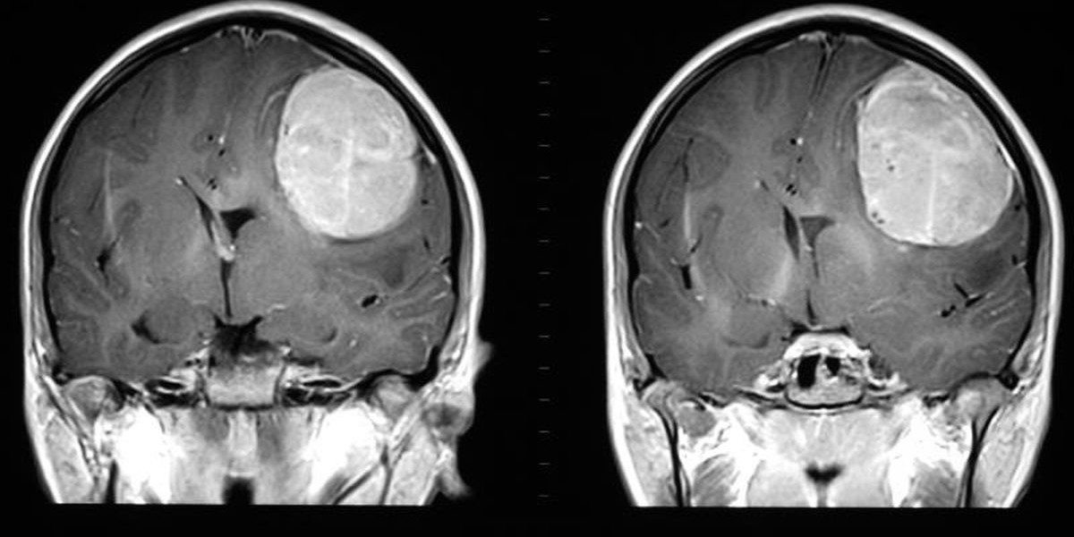 Top Trends In The Glioblastoma Market Size 2025: Advancing Breakthrough Brain Cancer Treatments