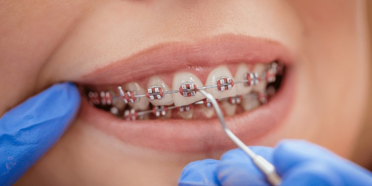 The Impact of Dental Braces on Your Overall Smile Aesthetics