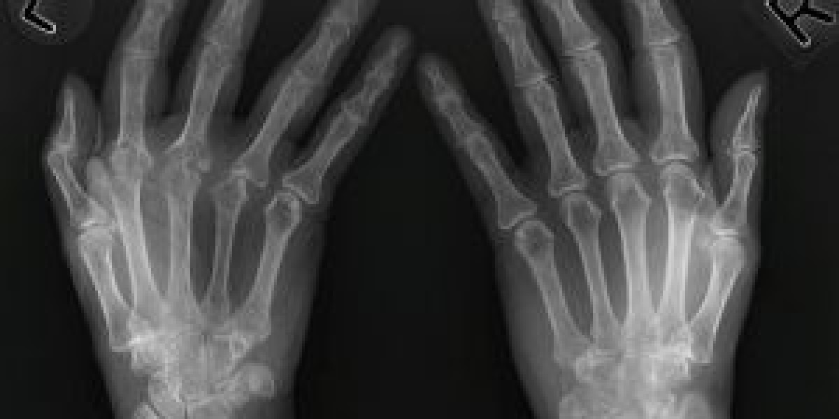 Erosive Hand Osteoarthritis Market Size, Trends, and Growth Outlook 2025-2032