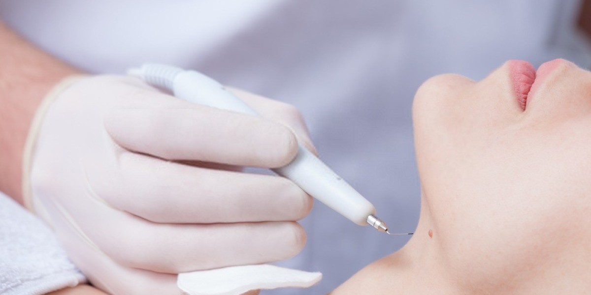 Warts Removal Surgery vs Laser: What’s Best