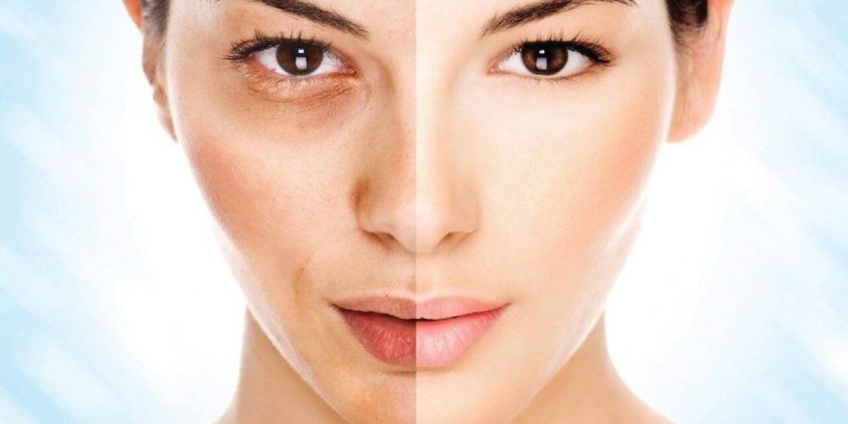 Choosing the Right Specialist for Birthmark Removal in Dubai