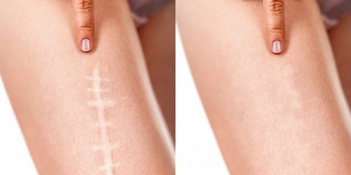 Scar Removal in Dubai for Teenagers: Safe and Effective Solutions