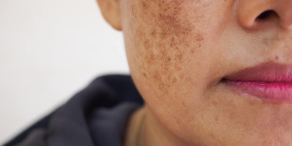 Melasma Treatment: Get Doctor-Recommended Solutions