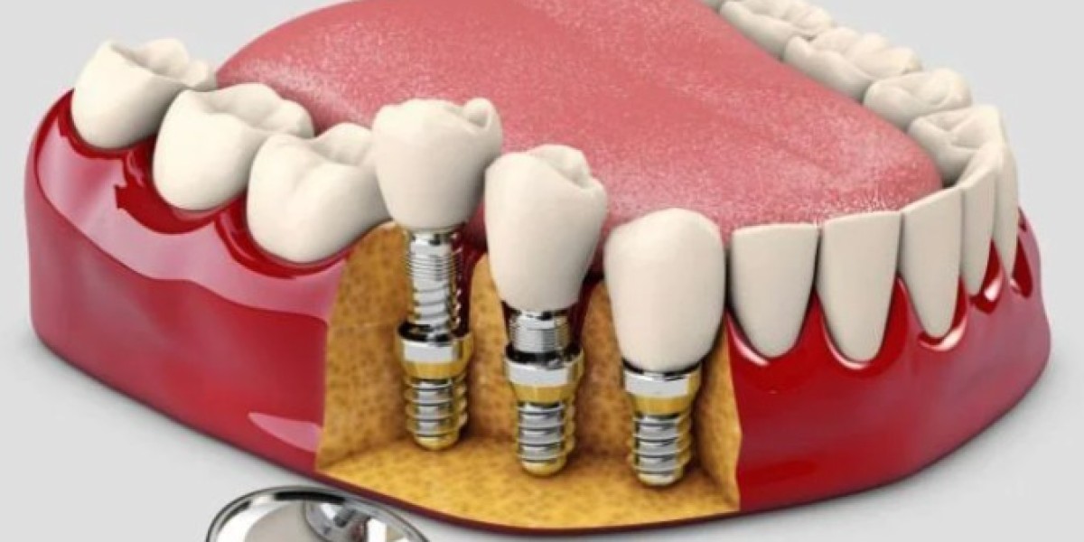 Trồng răng implant có vĩnh viễn không? Duy trì bao lâu?