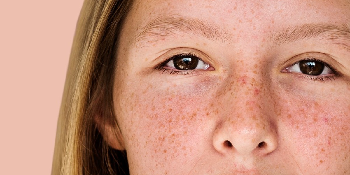 Can Dermal Pigmentation Correct Uneven Skin Tone?