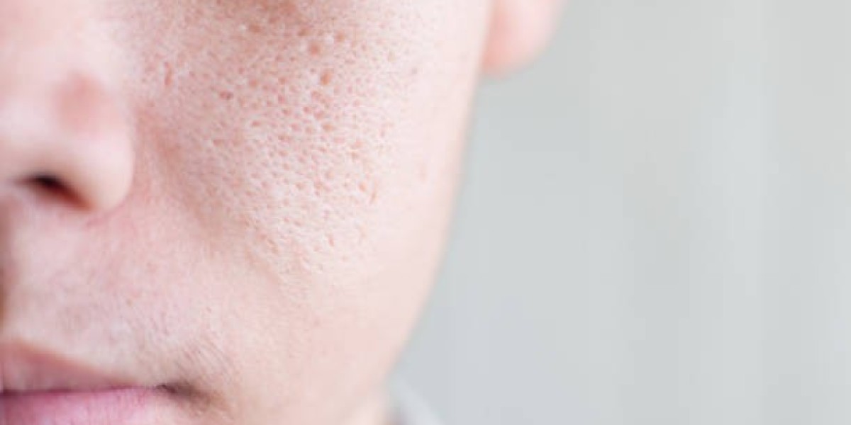 Open Pores Treatment: Aftercare Tips
