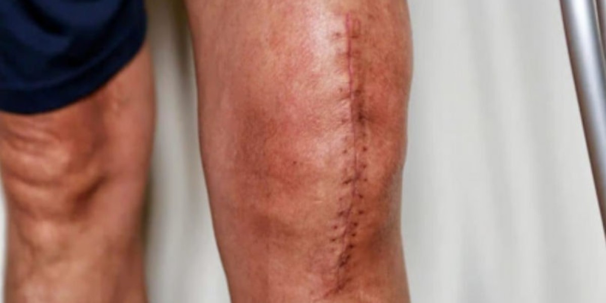 Inside Nagpur’s Best Hospital: What Really Happens During a Knee Replacement Surgery?