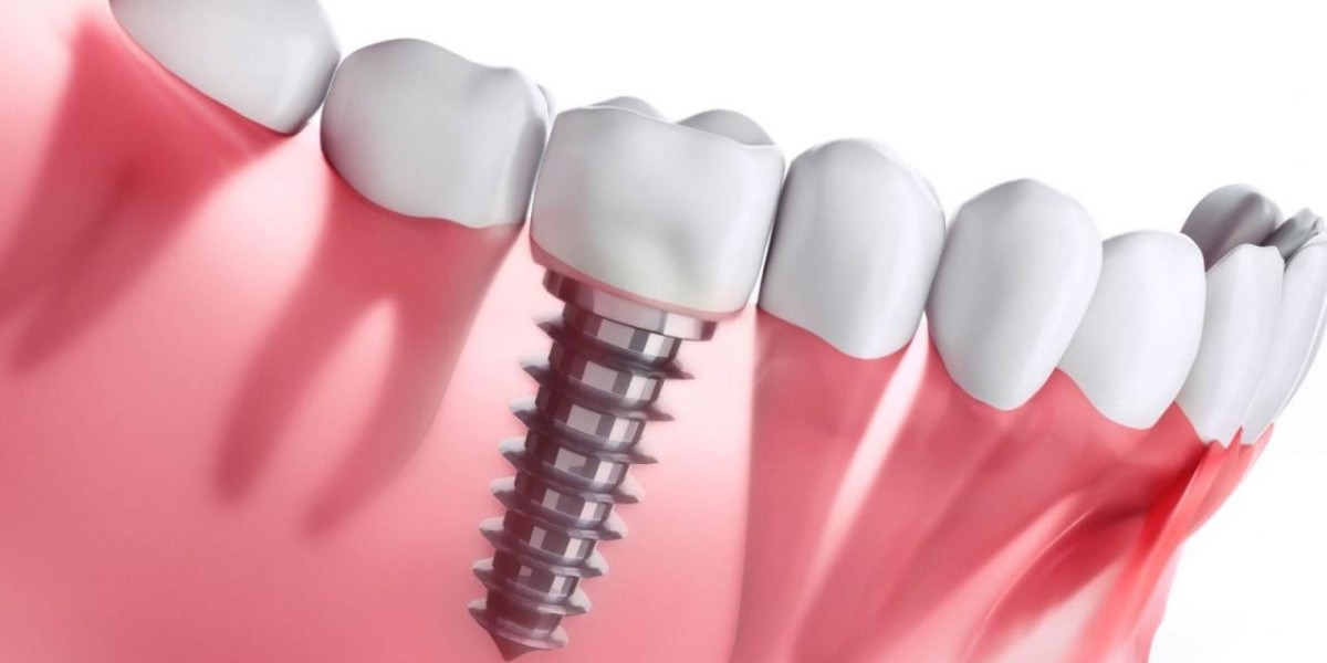 Dental Implant in Mumbai: A Comprehensive Technical Guide
