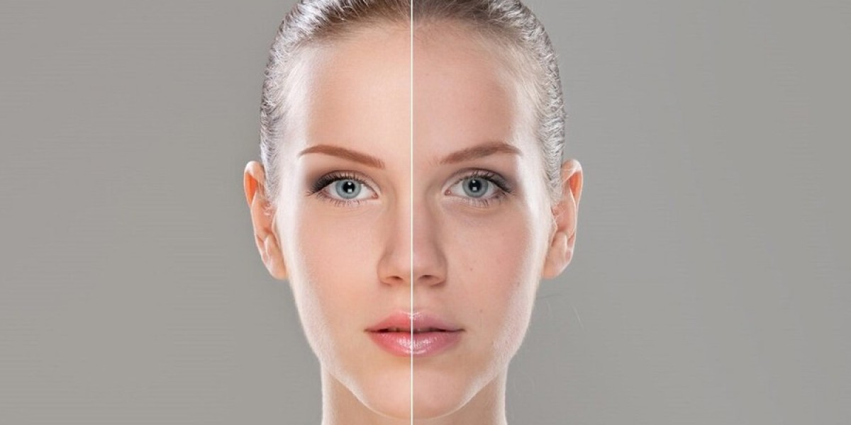 Best Hyperpigmentation Treatments in Dubai