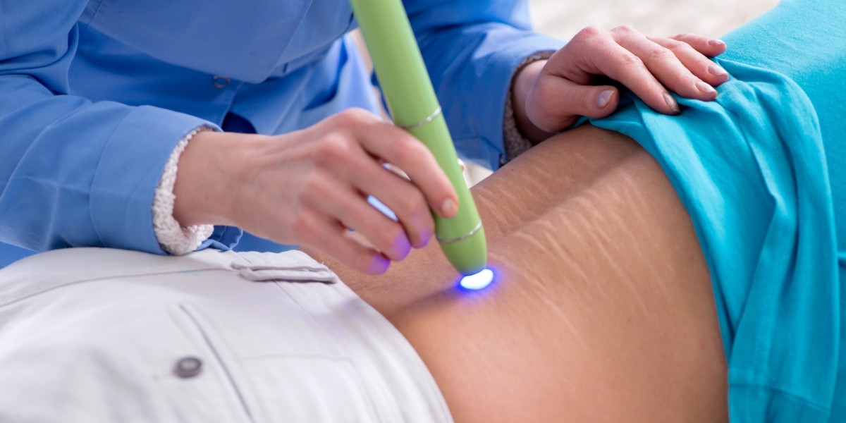 Scar Laser Treatment in 2025: New Techniques