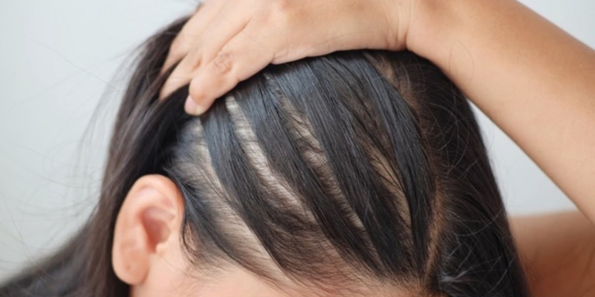 Crowning Confidence: Exploring the Best Female Hair Loss Treatment Options in Faisalabad