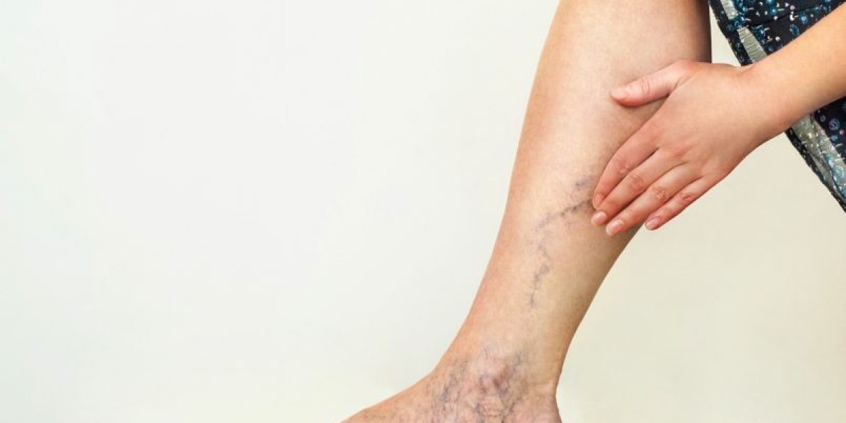 Success Stories: Spider Vein Patients in Riyadh
