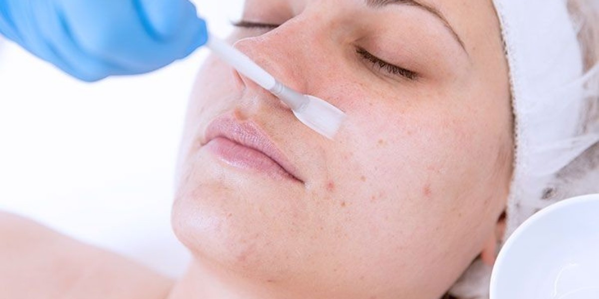 Are Chemical Peels Safe for All Skin Types?
