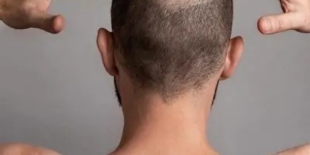 Women’s Hair Transplant in Dubai: Solving Thinning and Volume Loss