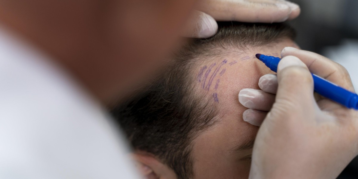 Hair Transplant in Dubai That Brings Confidence Back