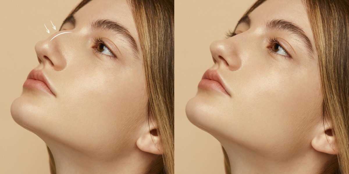 Is Liquid Rhinoplasty in Dubai Safe? What You Should Know Before Booking