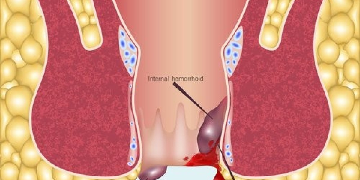 Laser Hemorrhoid Removal in Riyadh Explained