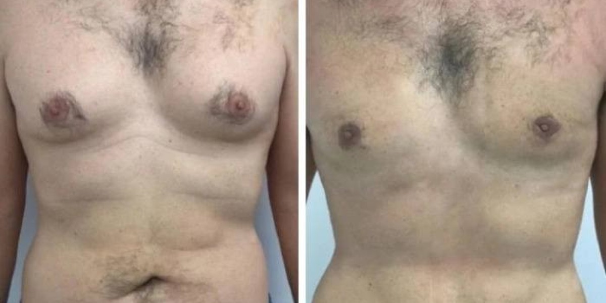 Gynecomastia in Dubai and the Impact of Steroids