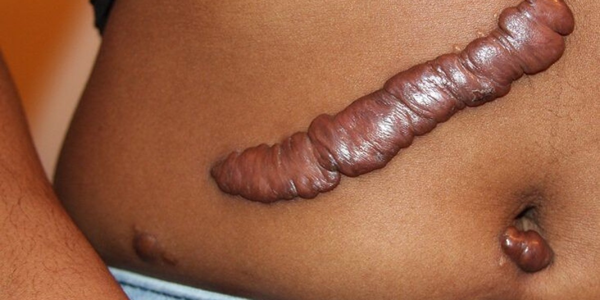 What Is The Most Effective Keloid Treatment?