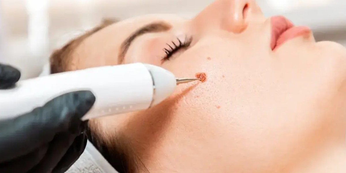 Mole removal at home vs professional clinics in Riyadh