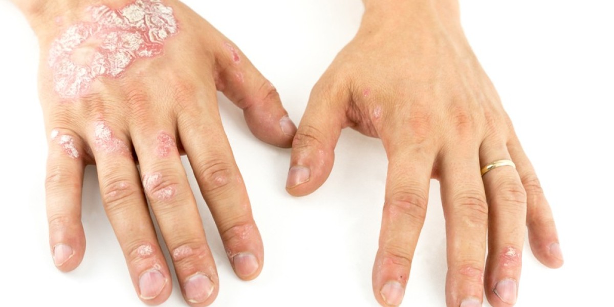 Chronic Plaque Psoriasis Market: Size, Trends, and Strategic Insights 2025-2032