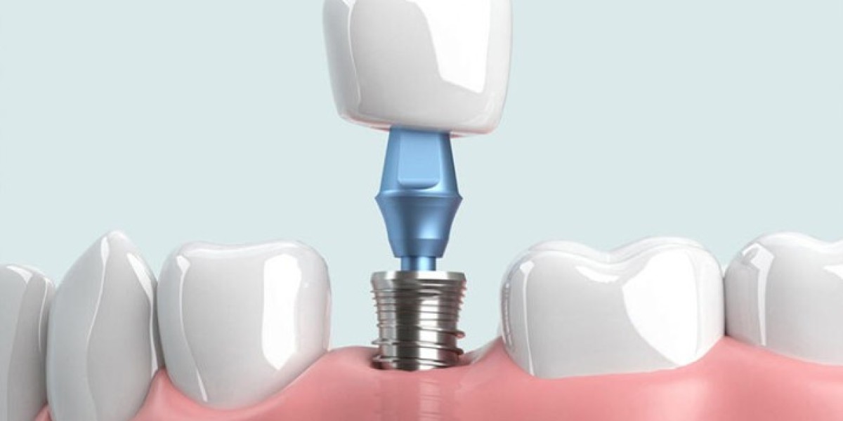 Trồng Răng Implant Bao Lâu Thì Lành?
