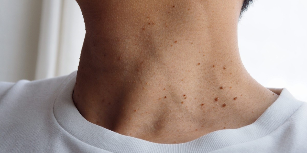 Does Skin Tag Removal Require Multiple Sessions?