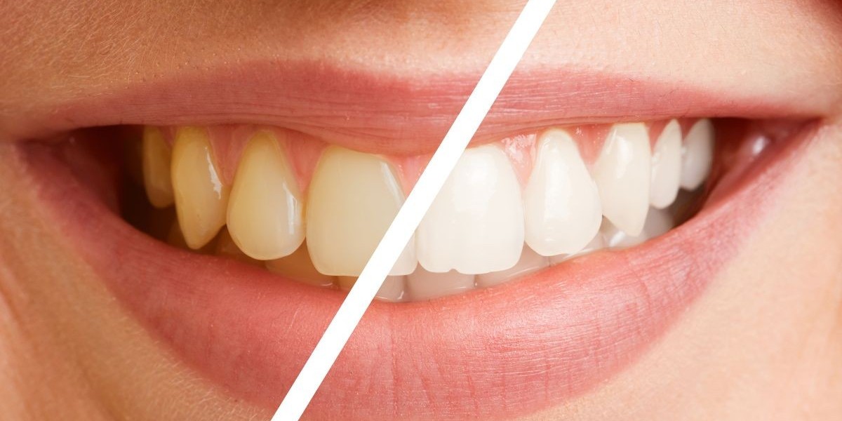 What Affects Teeth Whitening Cost More Than You Realize?