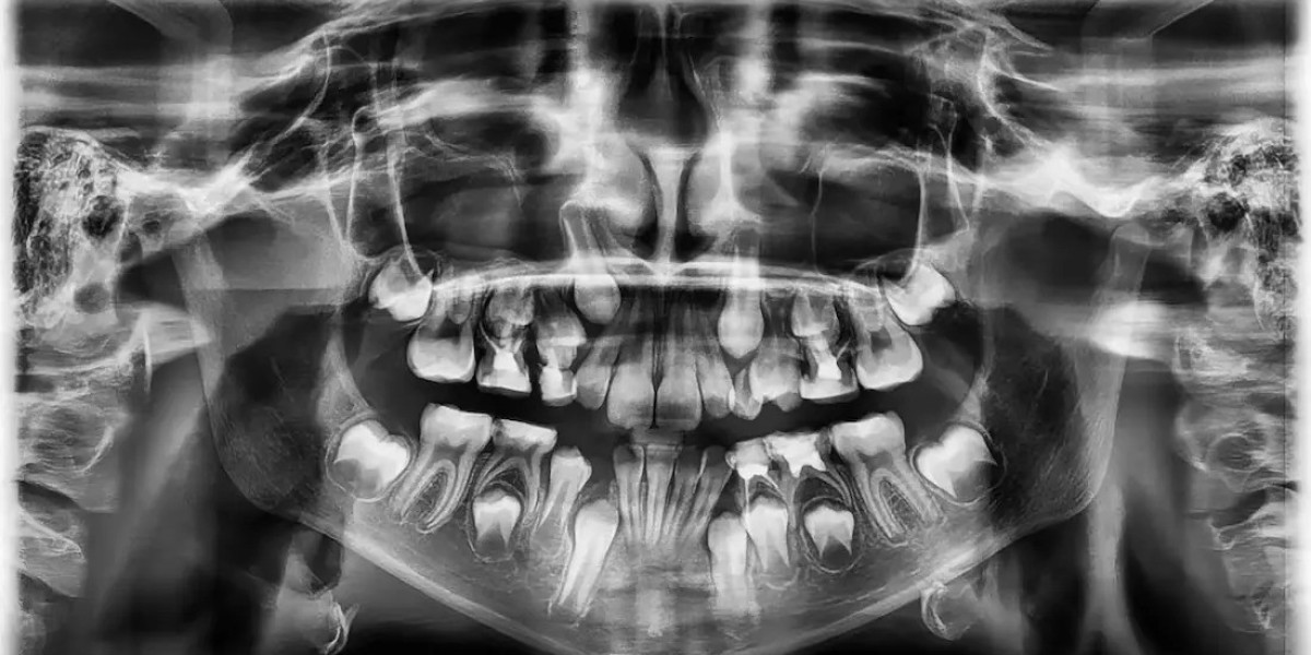 Surprising Factors That Affect Panoramic Dental X-Ray Cost