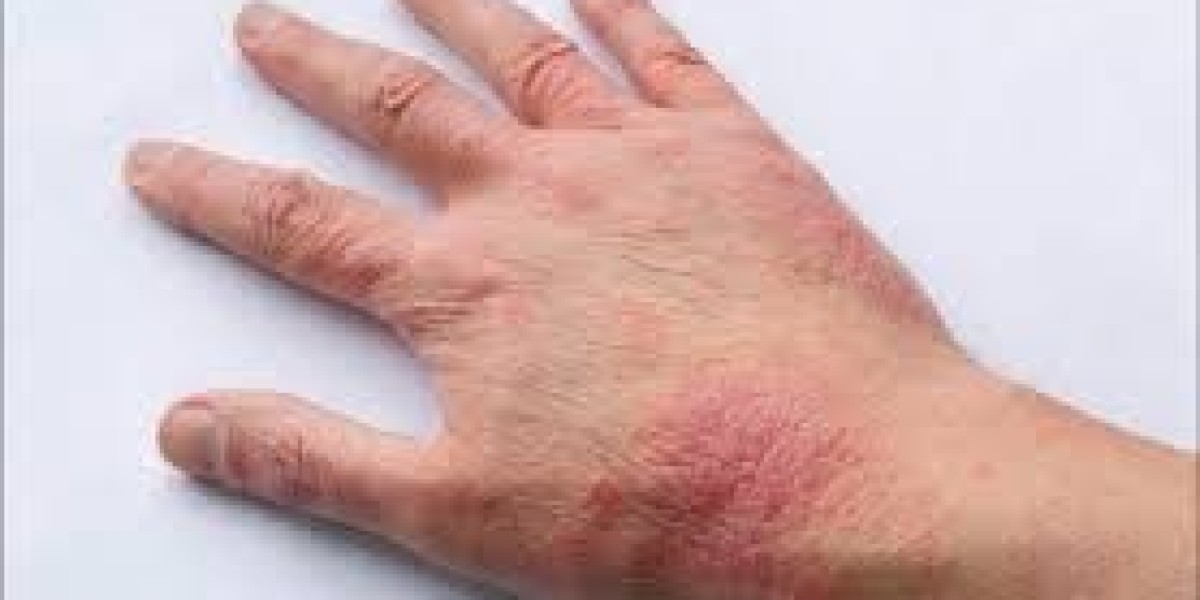 Atopic Dermatitis Market Growth Driven by Rising Prevalence and Demand for Advanced Topical Solutions