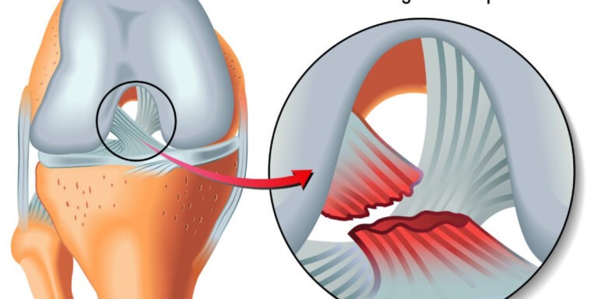 Emerging Dynamics and Growth Trajectory in Anterior Cruciate Ligament Injuries Market