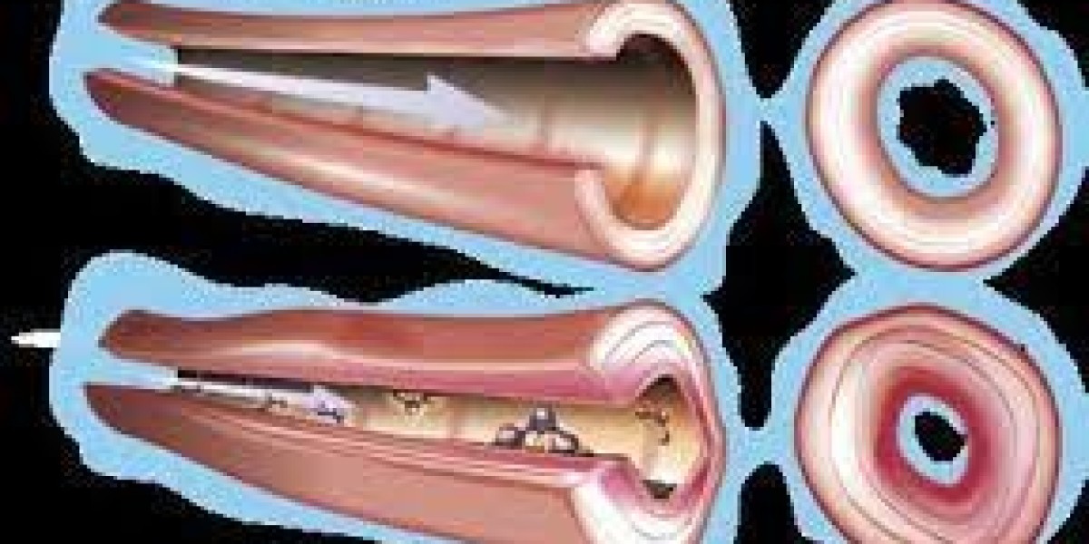 Emerging Demand in the Microscopic Polyangiitis Market Size: Share Insights from Hospital to Online Pharmacies