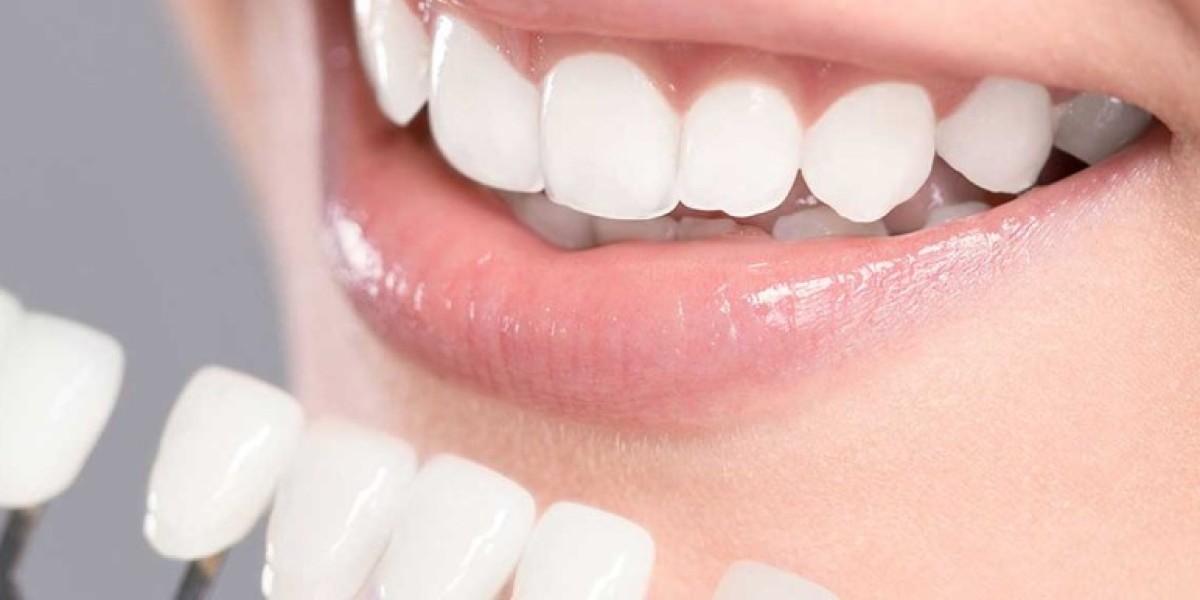 Everything You Need to Know Before Getting Veneers