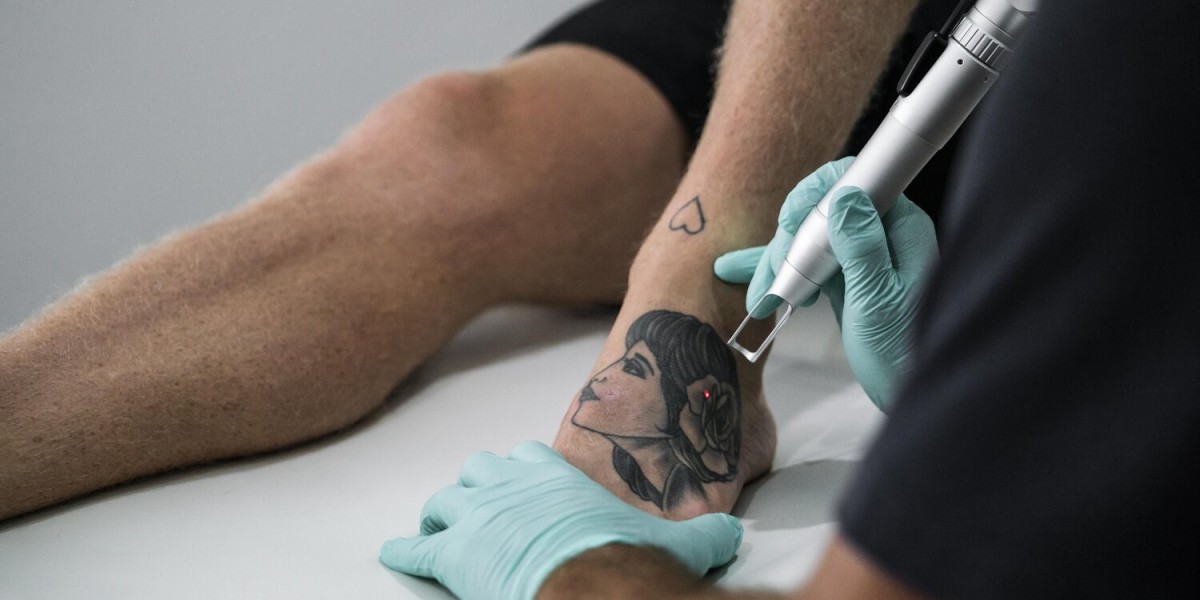 Time for a Reset with Laser Tattoo Removal Dubai