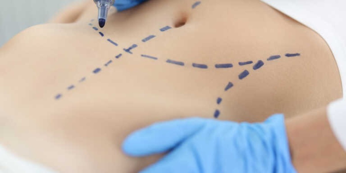 What Is Bariatric Surgery?