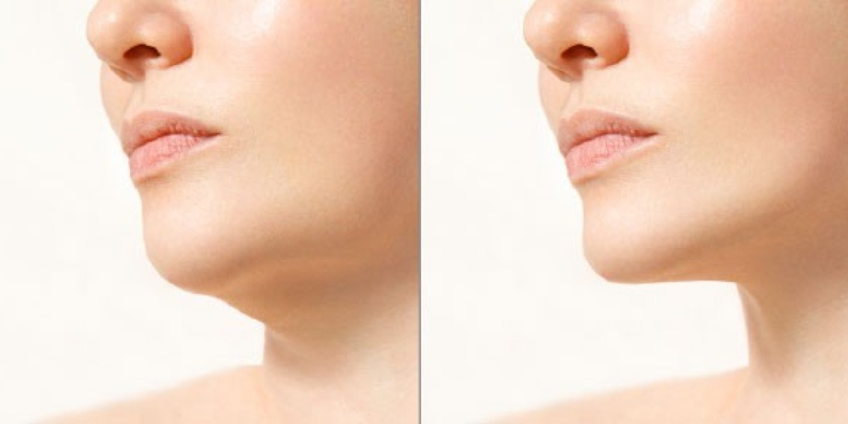 Thread Lift for Jawline Tightening and Chin Contour in Riyadh