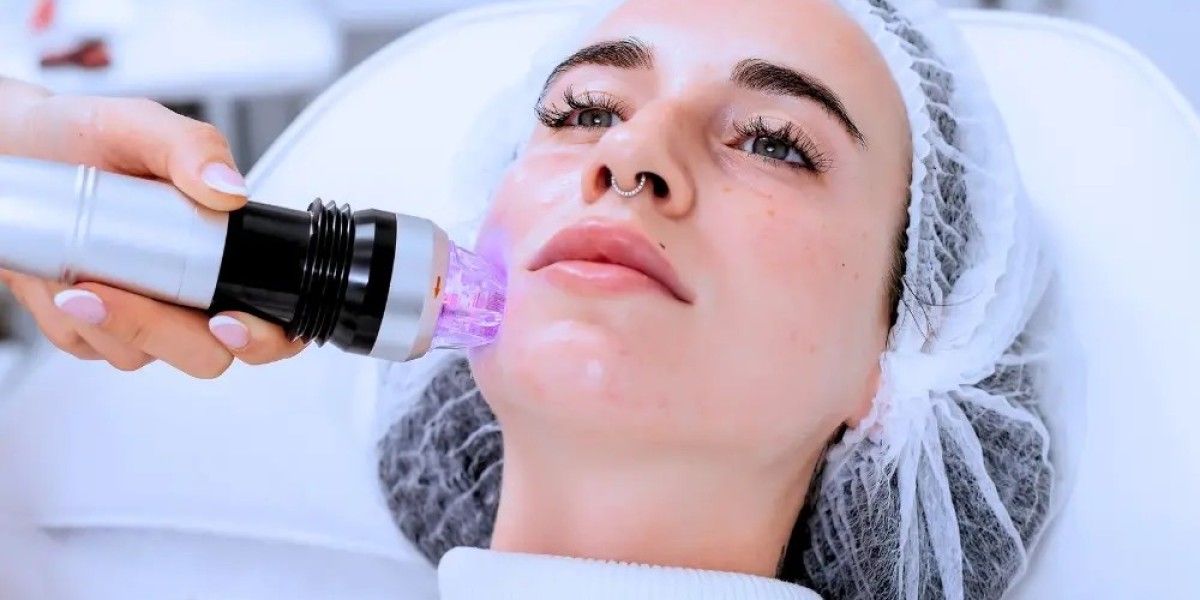 Post-Acne Marks Gone with Fractional RF Microneedling Magic!