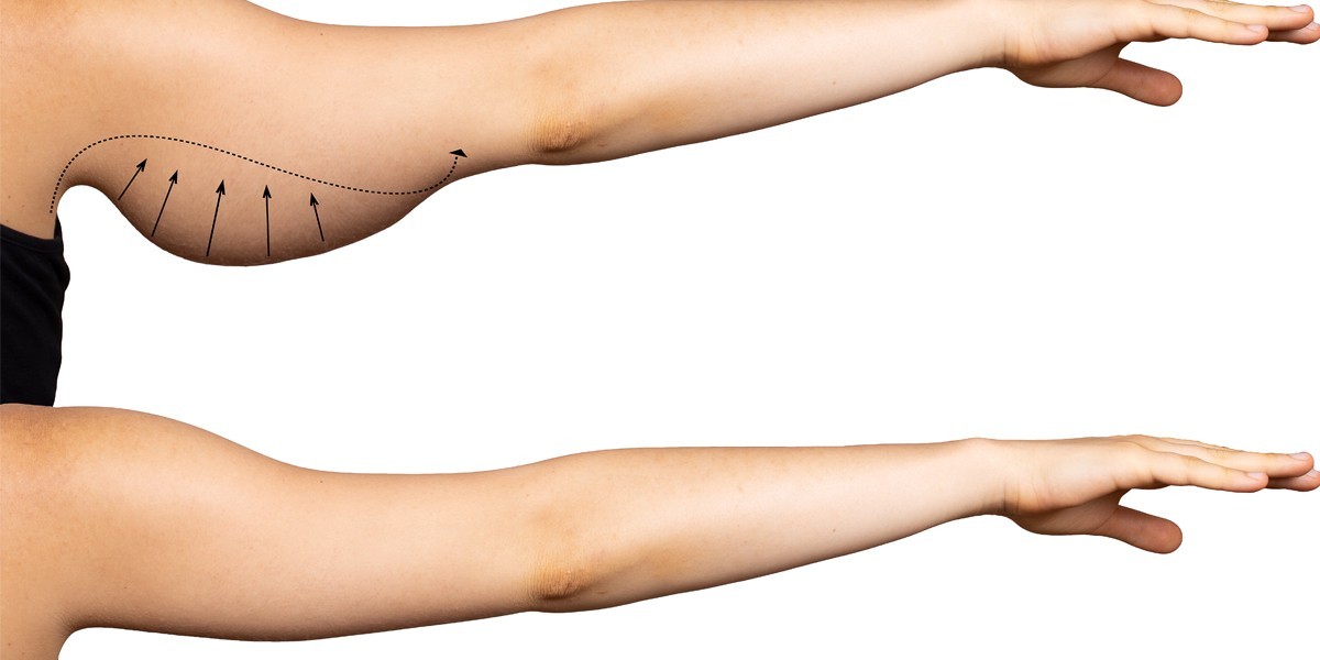 Common Techniques Used for Surgical Arm Fat Reduction in Islamabad