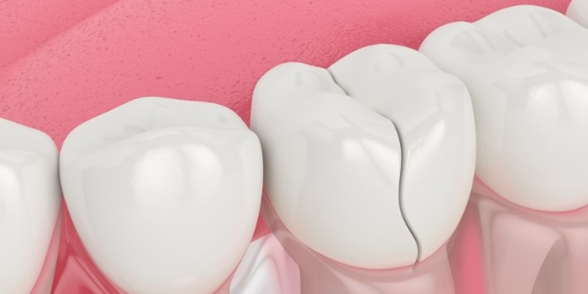 Bọc Sứ Cho Răng Cửa Bị Mẻ Giá Bao Nhiêu?